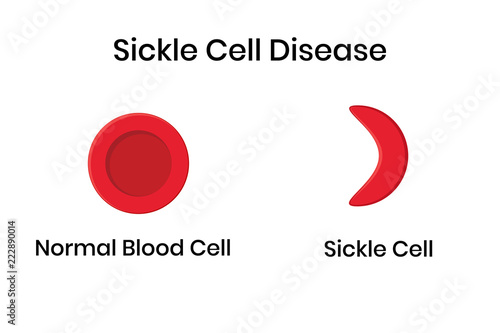 Sickle cell anemia. Normal erythrocyte against distorted sickle cell. photo