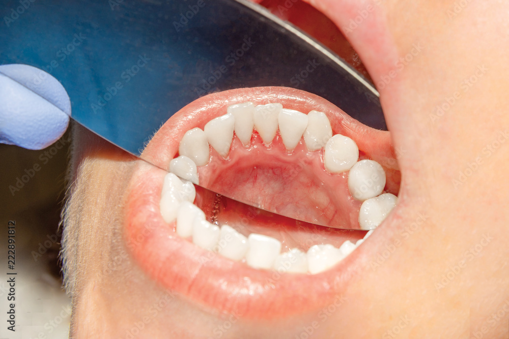 Foto de Plaque of the patient, stone. Dentistry treatment of dental