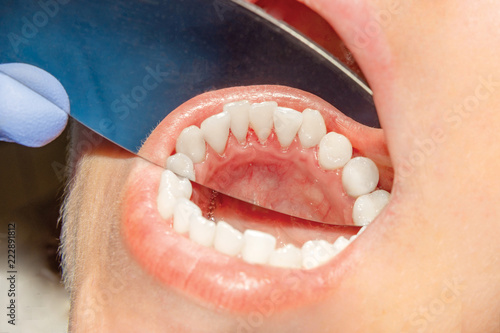 Plaque of the patient, stone. Dentistry treatment of dental plaque, professional oral hygiene. The concept of harm to smoking and cleaning teeth