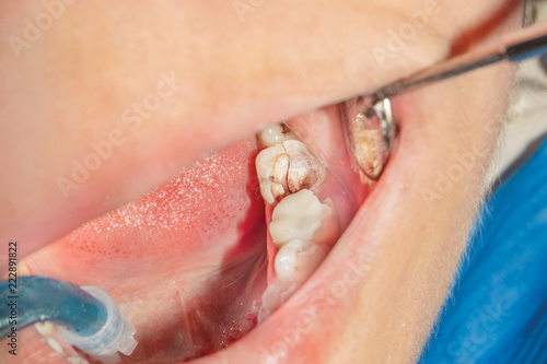 close-up of a fracture of a human molar tooth fracture. The concept of dental prosthetics and restoration of tooth loss