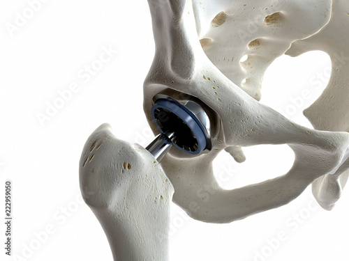 Cuadro en lienzo 3d rendered medically accurate illustration of a hip replacement