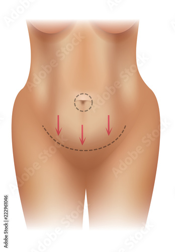 Female obese body with surgery lines colorful illustration on a white background