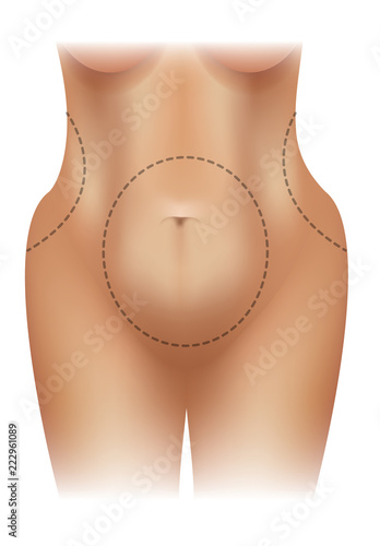 Female obese body with surgery lines colorful illustration on a white background