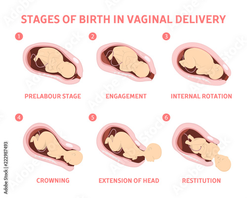 Stages of baby birth in vaginal delivery