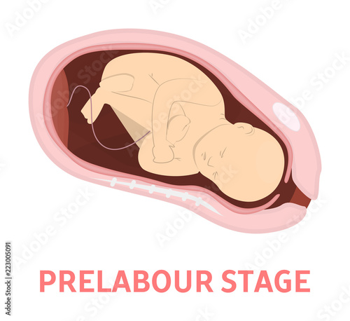 Prelabour stage of baby birth in vaginal delivery