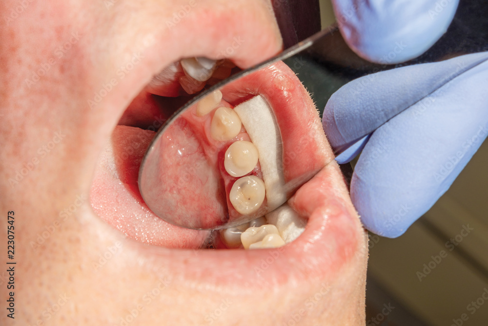 Obraz premium Restoration of the molar of a human tooth with filling material. The concept of aesthetic restorative dentistry in a dental clinic