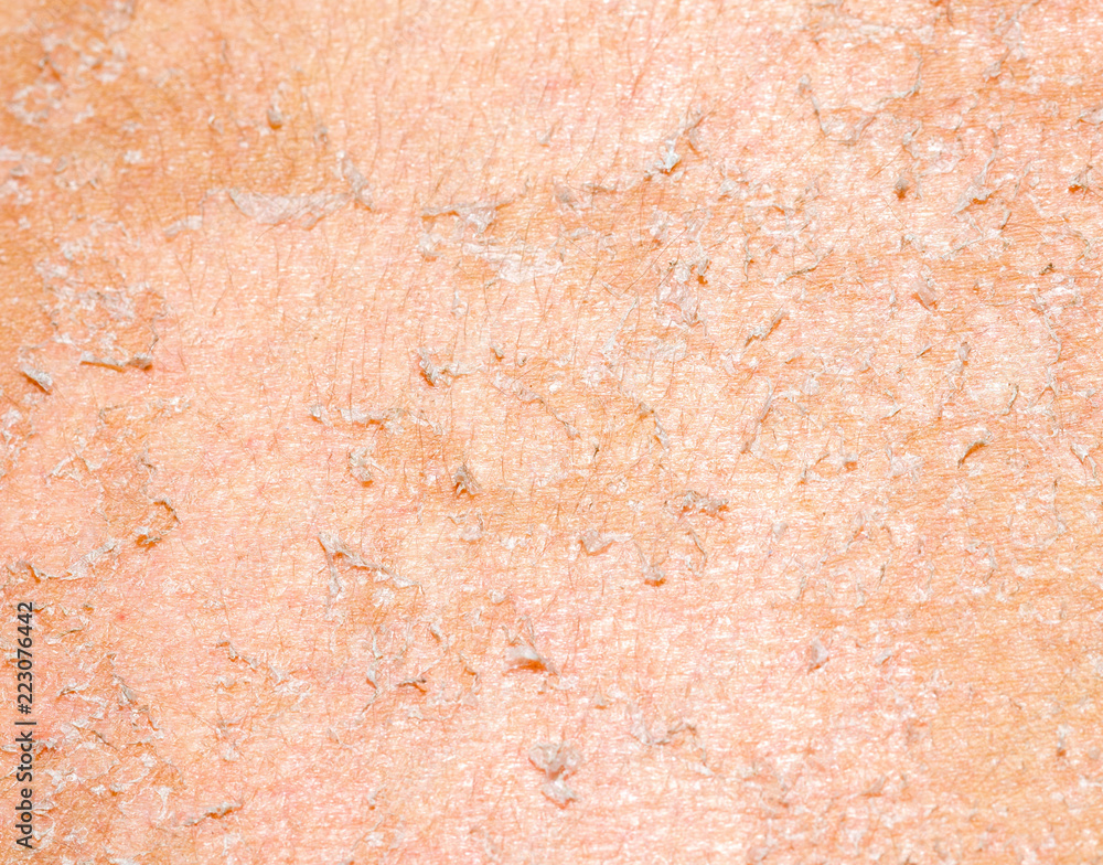 burned skin macro burned skin macro