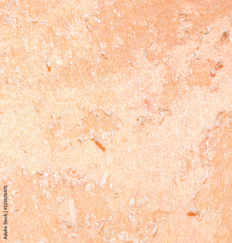 Fototapeta premium burned skin macro