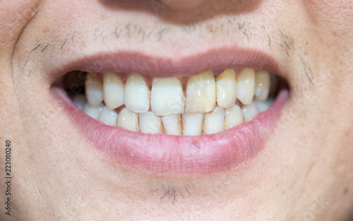 mouth and teeth of a man close up