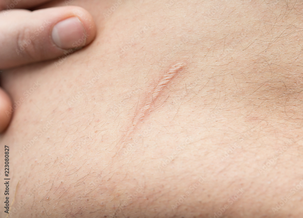 Fototapeta premium appendicitis scar on the man's stomach