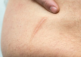 appendicitis scar on the man's stomach