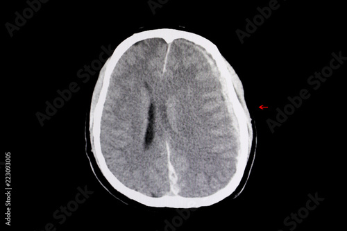 Slika na platnu CT brain intracerebral hemorrhage and brain edema