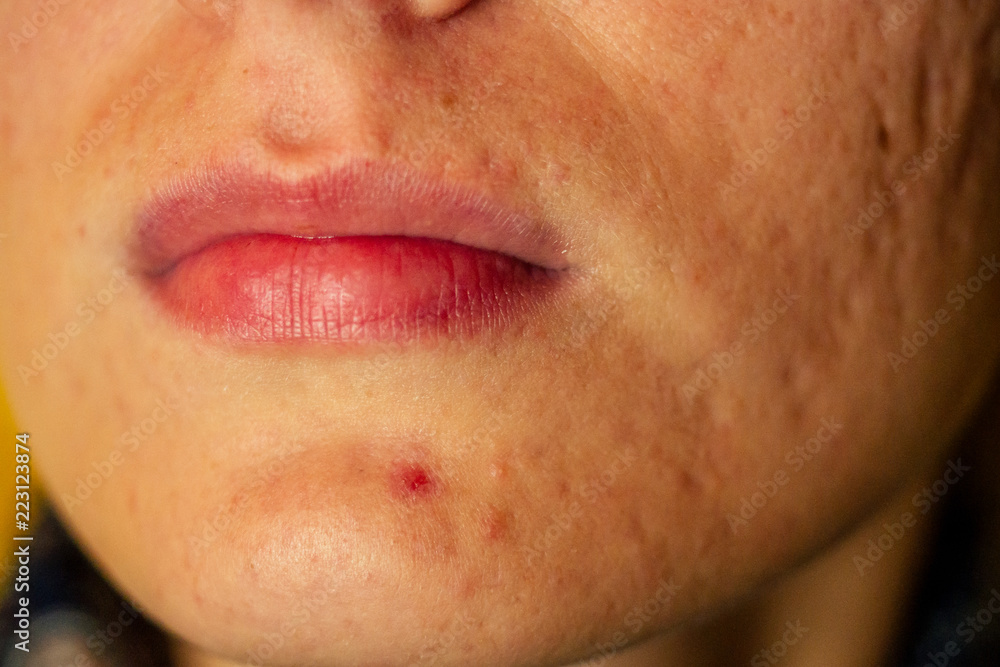 post-acne, scars and red festering pimples on the face of a young woman. concept of skin problems and harmonic failure post-acne, scars and red festering pimples on the face of a young woman. concept of skin problems and harmonic failure