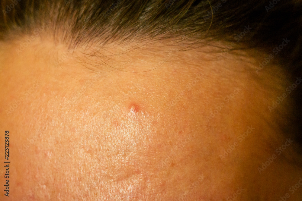 Fototapeta premium post-acne, scars and red festering pimples on the face of a young woman. concept of skin problems and harmonic failure