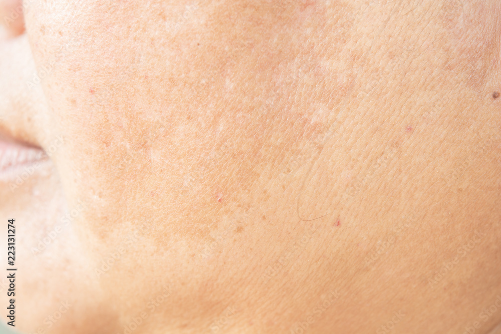 Fototapeta premium freckles on the face. in old women