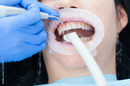 A woman in the dental hygienic and dental clinic professional teeth whitening and ultrasonic cleaning. Odontics and health of the mouth.