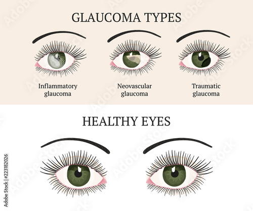 Eye disease. Ophthalmology health illustration.
