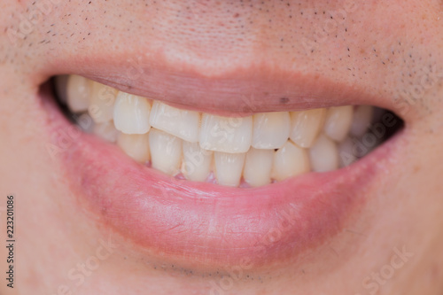 ugly smile dental problem. Teeth Injuries or Teeth Breaking in Male. Trauma and Nerve Damage of injured tooth, Permanent Teeth Injury.