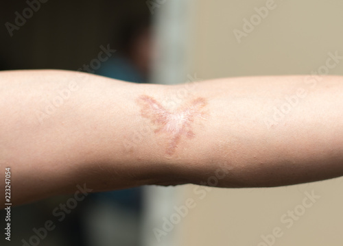 Foto A scar in one's hand