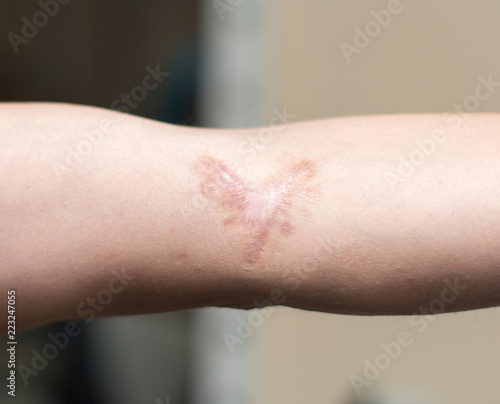 Photography A scar in one's hand