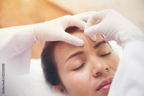 Relaxed Young asian Woman Receiving Acupuncture Treatment In Beauty Spa