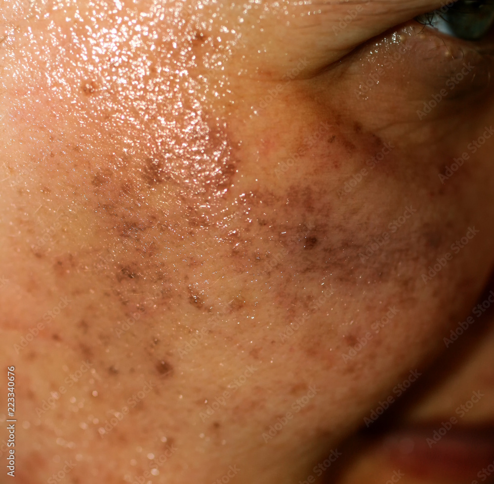 Naklejka premium Pigmented spots on the face. Pigmentation on cheeks