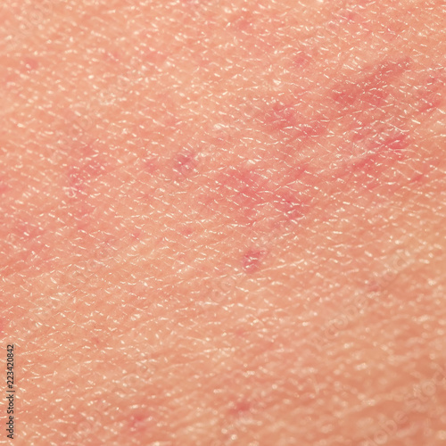 sick human skin texture covered with red allergic spots and irritations