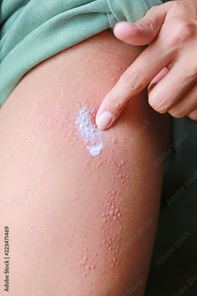 Applying ointment to dermatitis skin allergic rash. Stock Photo | Adobe  Stock