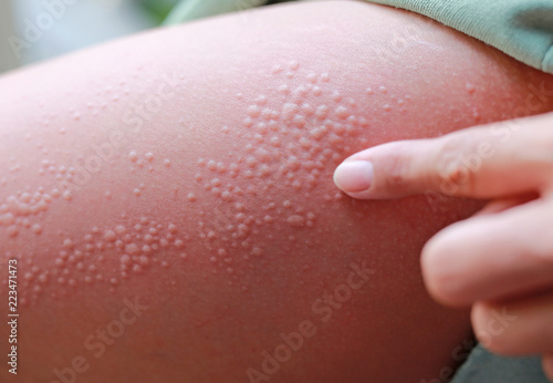 Allergic rash dermatitis eczema on skin.