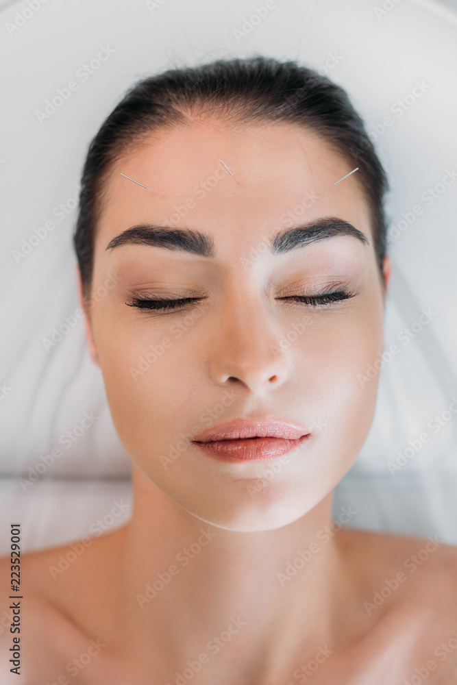 overhead view of woman relaxing while having acupuncture therapy in spa salon