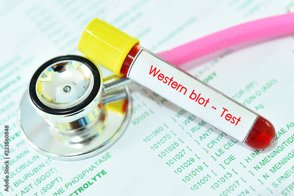 Blood sample tube for Western blot test, confirmatory test for HIV