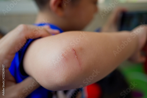 Bilde på lerret lesion elbow, children are elbow ulcers