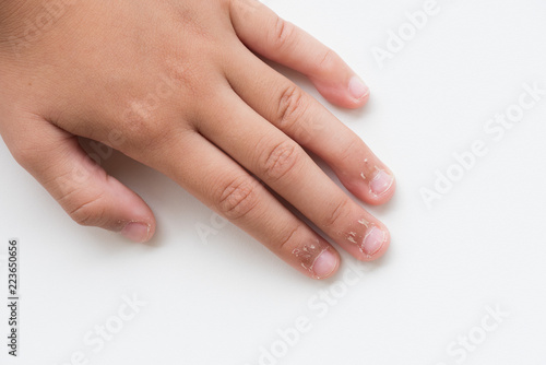 Close up child s fingers with dry skin  Eczema Dermatitis. Medicine and health care concept.