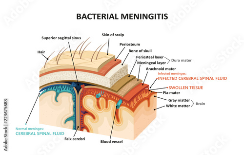 Bacterial meningitis photo
