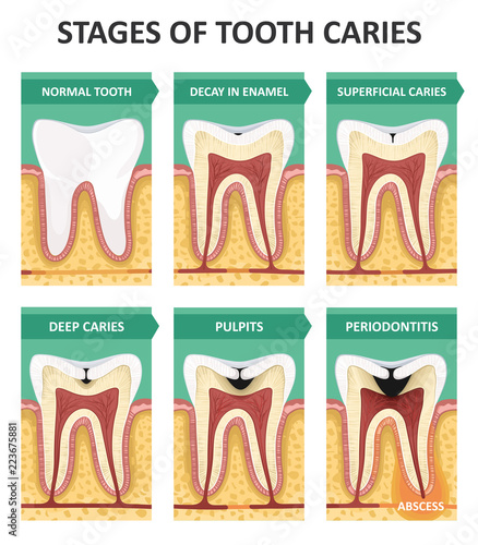 Stages of tooth caries