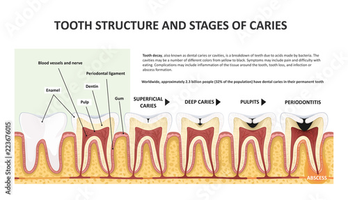 Tooth structure and stages of caries