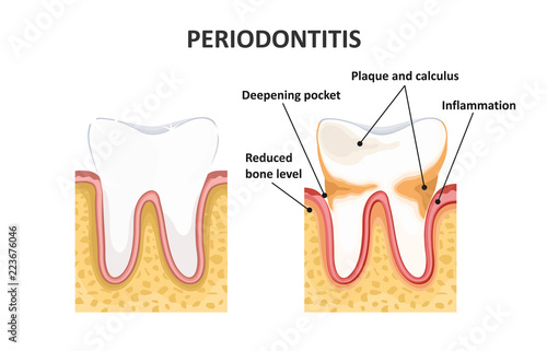 Periodontitis, dental disease. Inflammation of the gums