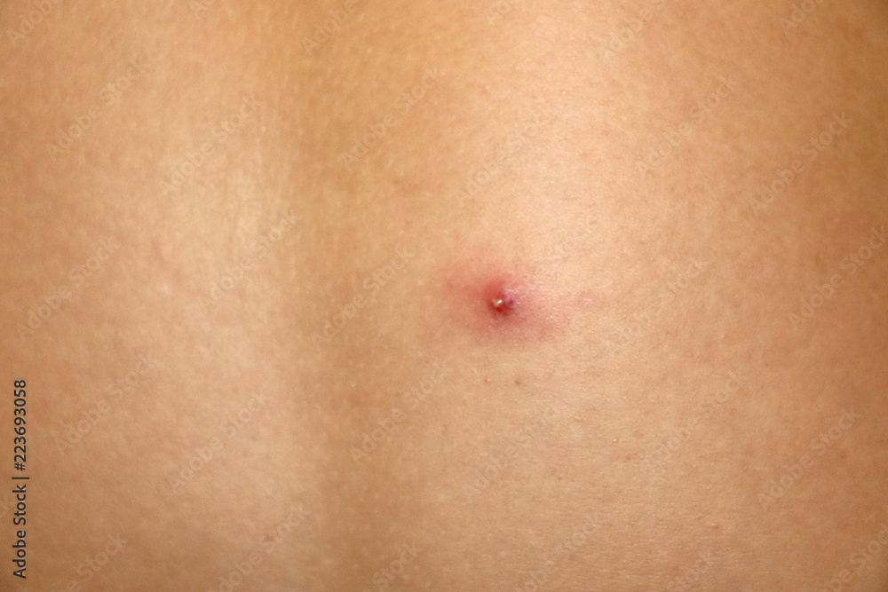 Close up of a pimple on the back Close up of a pimple on the back