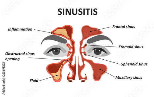 Sinusitis. Healthy and inflammation nasal sinus photo