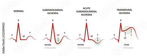 Diagnosis of Myocardial Ischemia (NSTEMI, STEMI) EKG of subendocardial ischemia and transmural ischemia photo