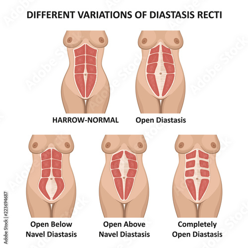 different variations of diastasis recti