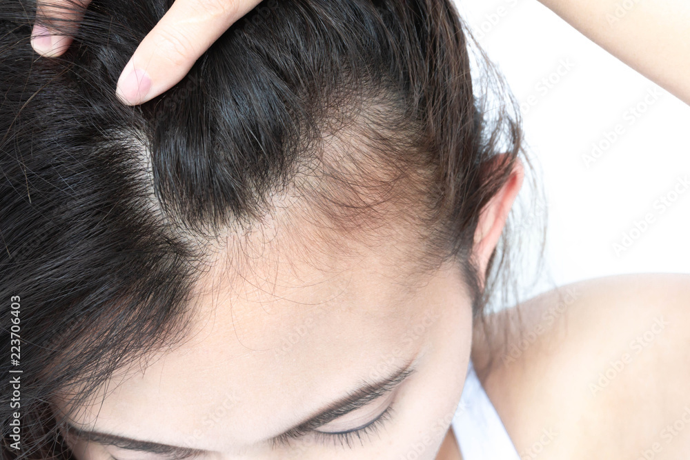 Woman serious hair loss problem for health care shampoo and beauty product concept Woman serious hair loss problem for health care shampoo and beauty product concept