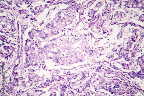 Mucinous carcinoma of the stomach  light micrograph  photo under microscope