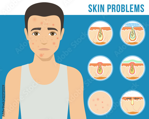 Man with a problem skin. Treatment of acne, skin care, men s cosmetics. Vector