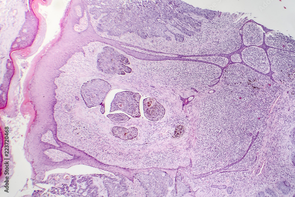 Basal cell carcinoma, skin cancer, light micrograph, photo under