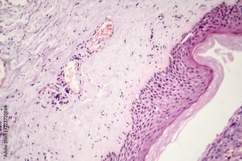 Basal cell carcinoma, skin cancer, light micrograph, photo under microscope photo