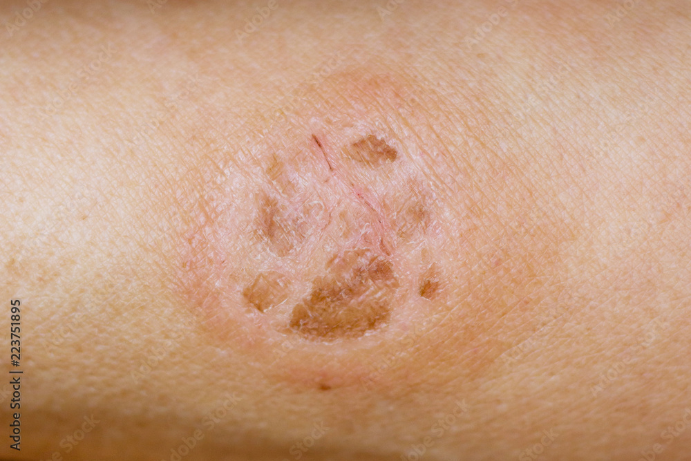 Dartre (lichen) on the skin of man. Infectious skin disease_ Stock Photo |  Adobe Stock