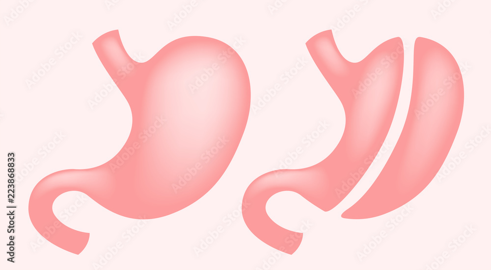 Laparoscopic Gastrectomy Gastric Sleeve / weight loss surgery vector Laparoscopic Gastrectomy Gastric Sleeve / weight loss surgery vector