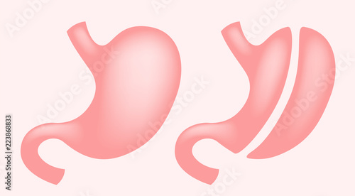 Laparoscopic Gastrectomy Gastric Sleeve / weight loss surgery vector