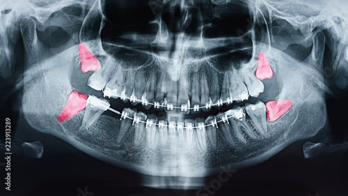 Rosnący ból zębów mądrości na zdjęciu rentgenowskim